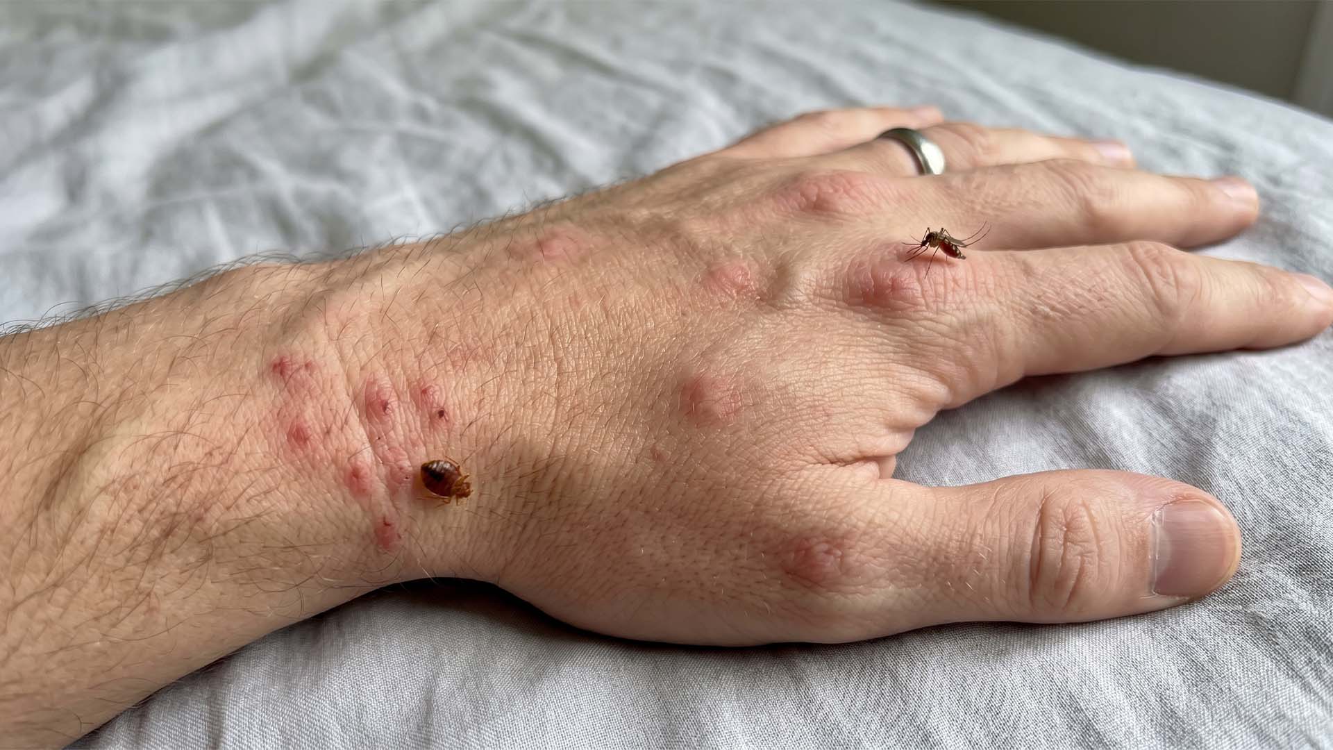 Ciri Ciri Digigit Kutu Kasur vs Nyamuk